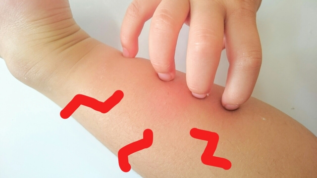 子どものデリケートな肌を守る！よくある皮膚トラブルとその対処法